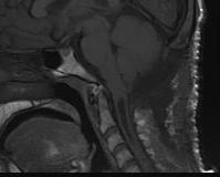 Arnold Chiari Malformation with syrinx